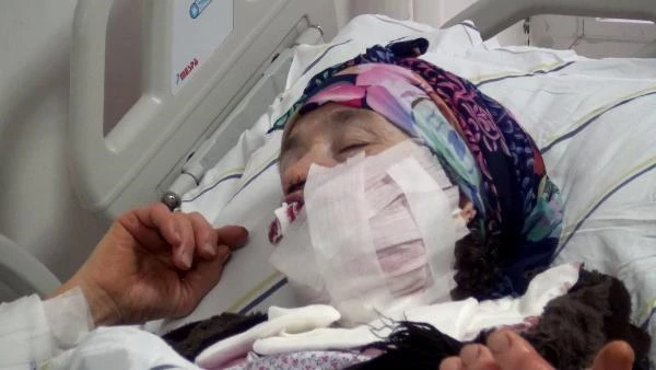 Kurdun saldırısına uğrayan kadının yüzü ameliyatla onarıldı