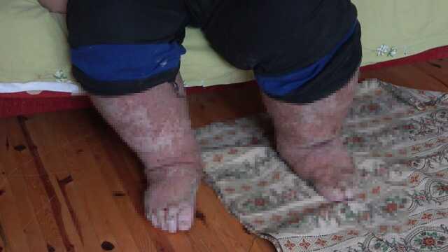 Sivrisinek, güvenlik görevlisinin hayatını kararttı