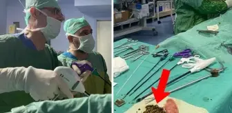 Siir'teki hastanın safra kesesinden tam 2 bin adet taş çıktı!