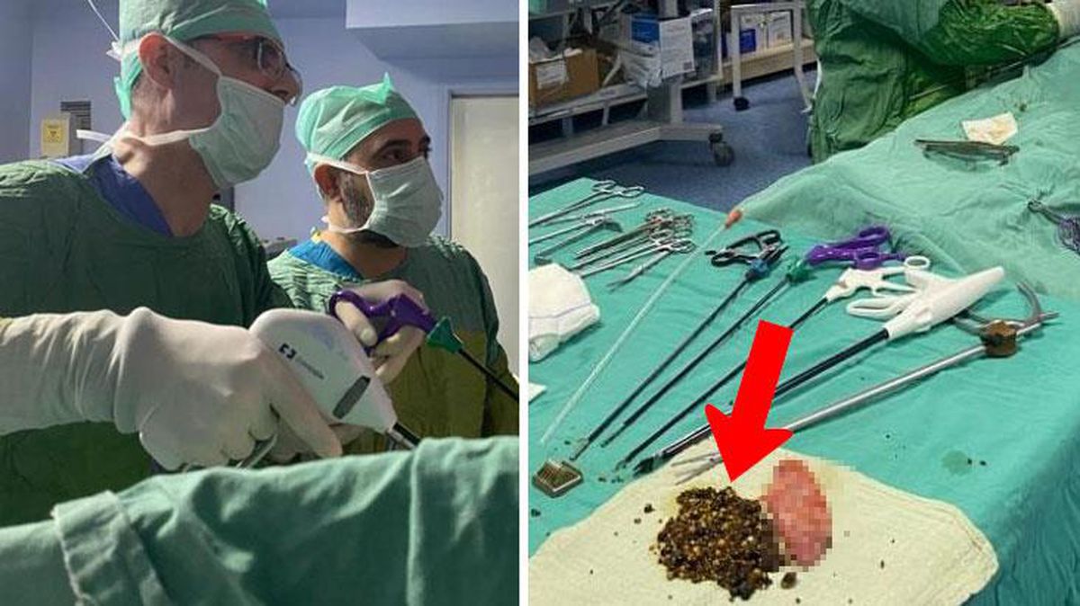 Siir'teki hastanın safra kesesinden tam 2 bin adet taş çıktı!