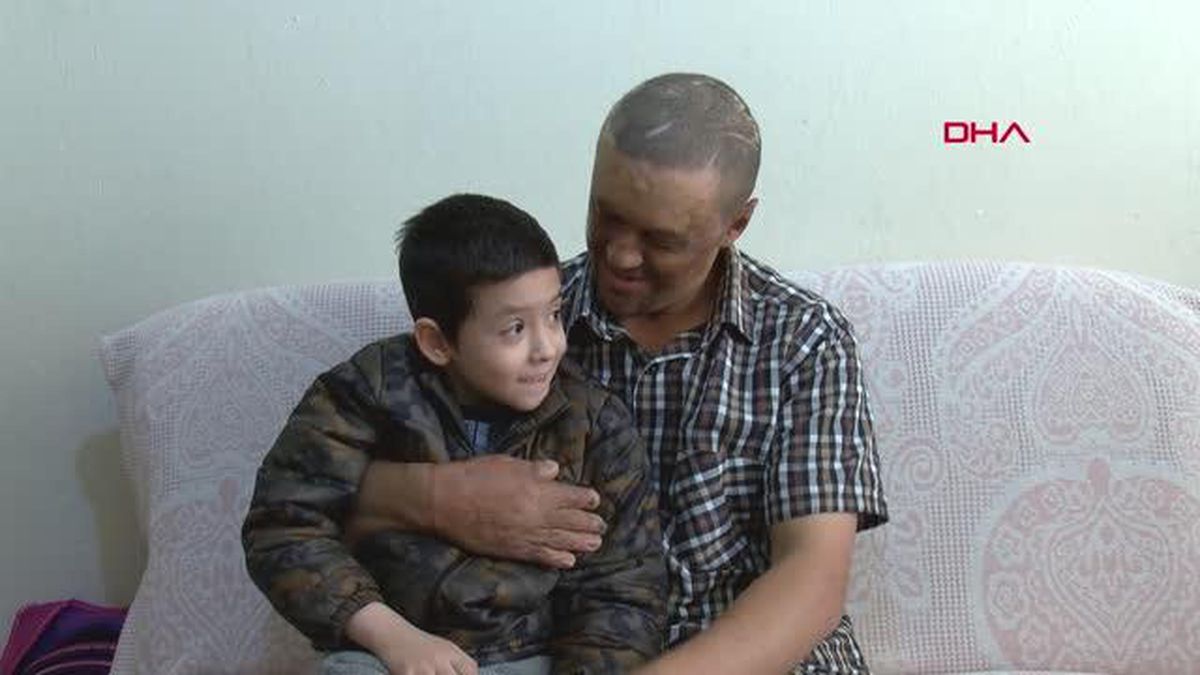 Yangında yaralanan ve dış görünüşü nedeniyle iş bulamayan adamın hikayesi