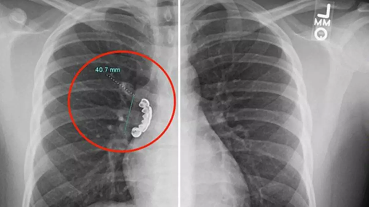 Kriz geçiren hastanın yanlışlıkla yuttuğu takma diş ciğerine saplandı