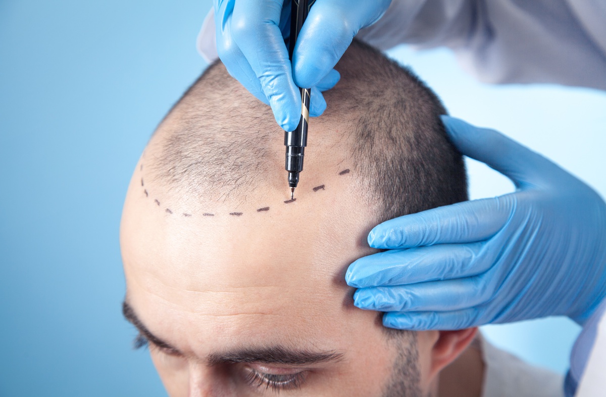 What is a FUE Hair Transplant? Is FUE Hair Transplant Permanent? Hair Transplant Before and After İstanbul, Türkiye