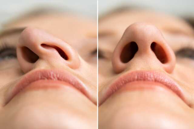 How much is a septorhinoplasty in Türkiye? Achieve Improved Nasal Function and Aesthetic Harmony with Septorhinoplasty How much is a septorhinoplasty in Türkiye? Achieve Improved Nasal Function and Aesthetic Harmony with Septorhinoplasty
