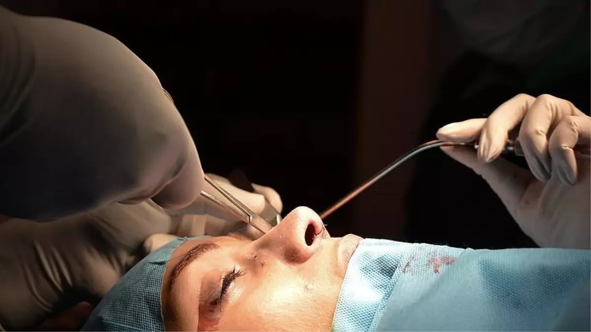 Do stitches inside the nose dissolve? Understanding Stitching Details after Rhinoplasty: A Comprehensive Guide