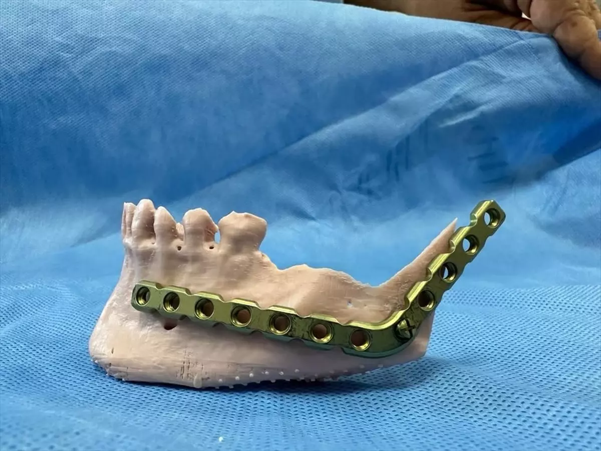 Sivas Ağız ve Diş Hastalıkları Hastanesinde kist ameliyatı ve 3D yazılım modelleme ile alt çene metal plak uygulaması yapılan hasta sağlığına kavuşturuldu