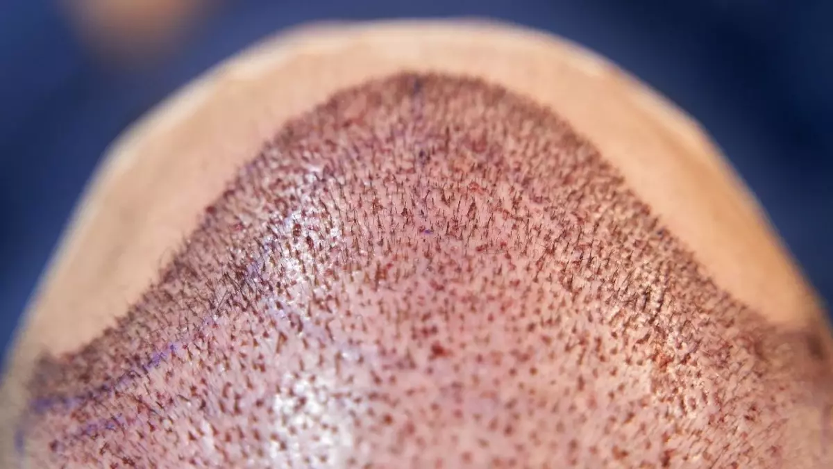 Türkiye\'nin saç ekimi merkezleri: Uzmanlık ve teknolojiyle tanınan seçenekler