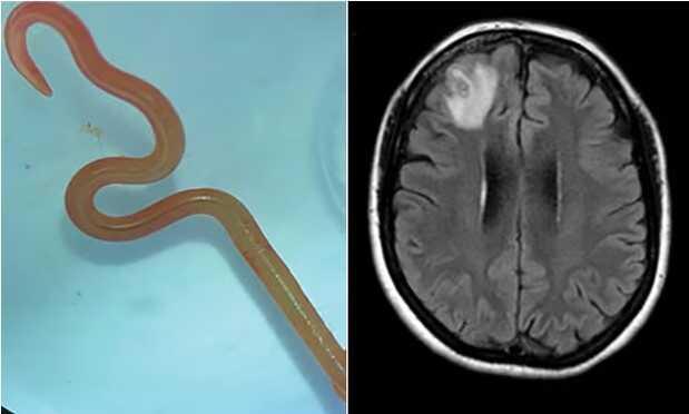 Depresyon ve unutkanlık şikayeti ile hastaneye giden kadının beyninde 8 santimlik canlı solucan bulundu