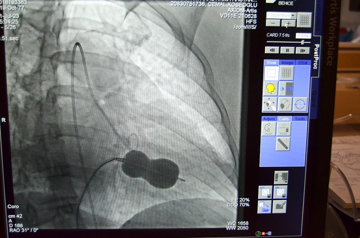 Alanya\'da mitral kalp kapağı darlığı ameliyatsız tedavi edildi