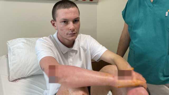 Deodorantın düğmesi basılı kaldı, çakmağı ateşledi 50'den fazla ameliyat oldu