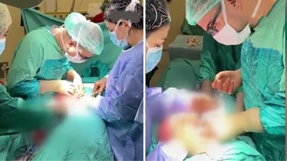Bitlis\'te bir hastanın rahminden 35 santimetre büyüklüğünde kist çıkarıldı