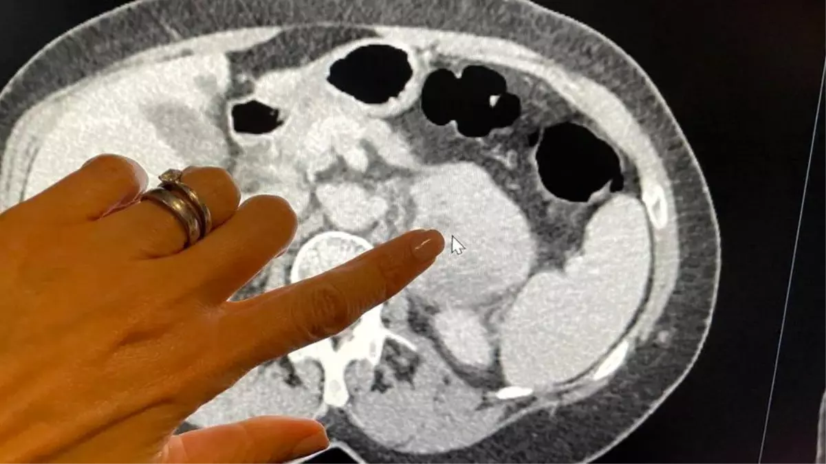 Yapay Zeka, Nadir Görülen Kanser Türünün Agresiflik Derecesini Belirlemede Başarılı