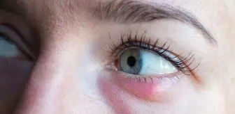 Arpacık nedir, neden oluşur? Arpacık nasıl geçer?