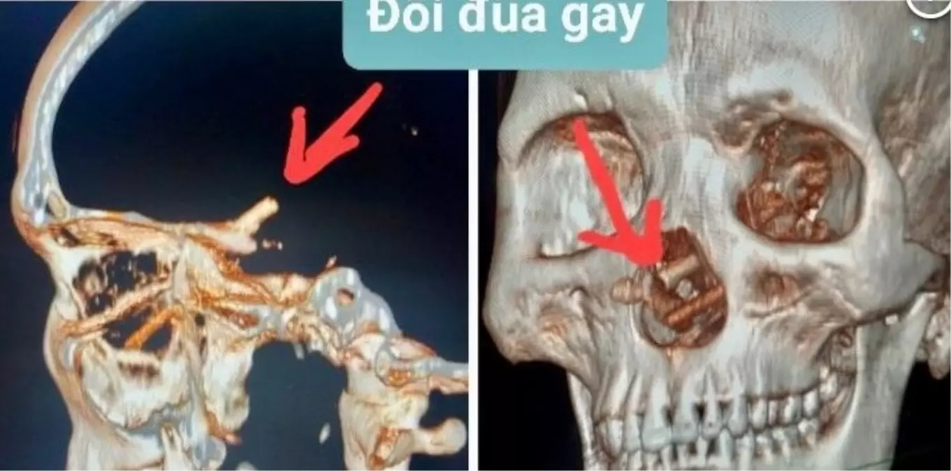 Aylardır başı ağrıyan adamın beyninde iki yemek çubuğu bulundu