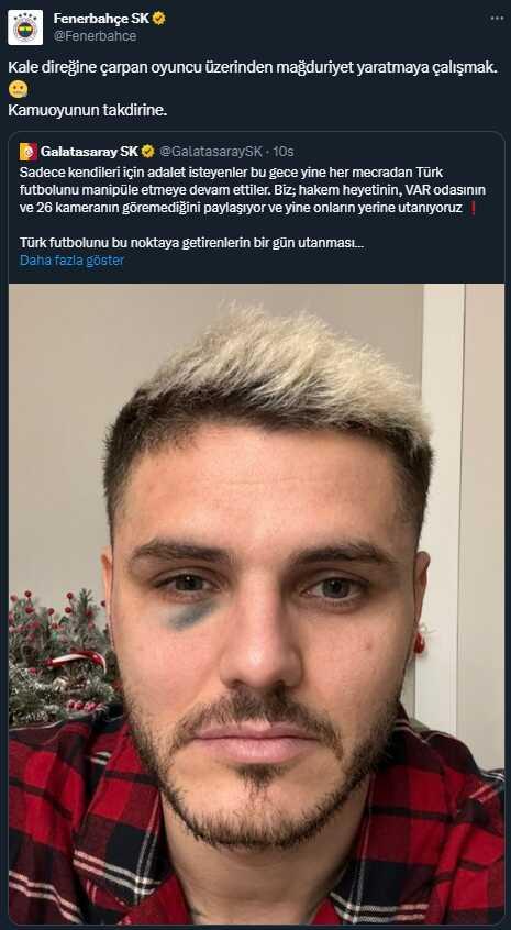 Icardi'nin gözü neden morardı? Ezeli rakiplerden farklı yönde paylaşımlar Icardi'nin gözü neden morardı? Ezeli rakiplerden farklı yönde paylaşımlar