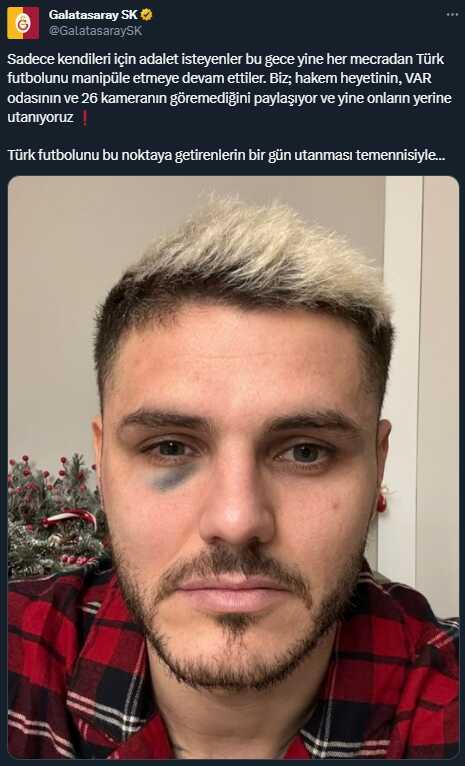 Maçta direğe çarpan Icardi'nin elmacık kemiği kırıldı Maçta direğe çarpan Icardi'nin elmacık kemiği kırıldı