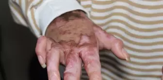 7 ayda 15 ameliyat! İş kazasında vücudunun yüzde 80'i yanmıştı! Liseli Beyzanur'un son görüntüsü yürek burktu