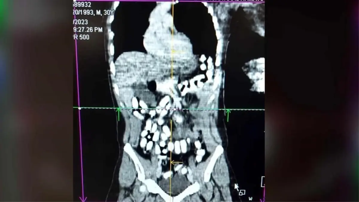 Erzincan\'da Midesinde 977,60 Gram Afyon Sakızı Taşıyan Şahıs Tutuklandı