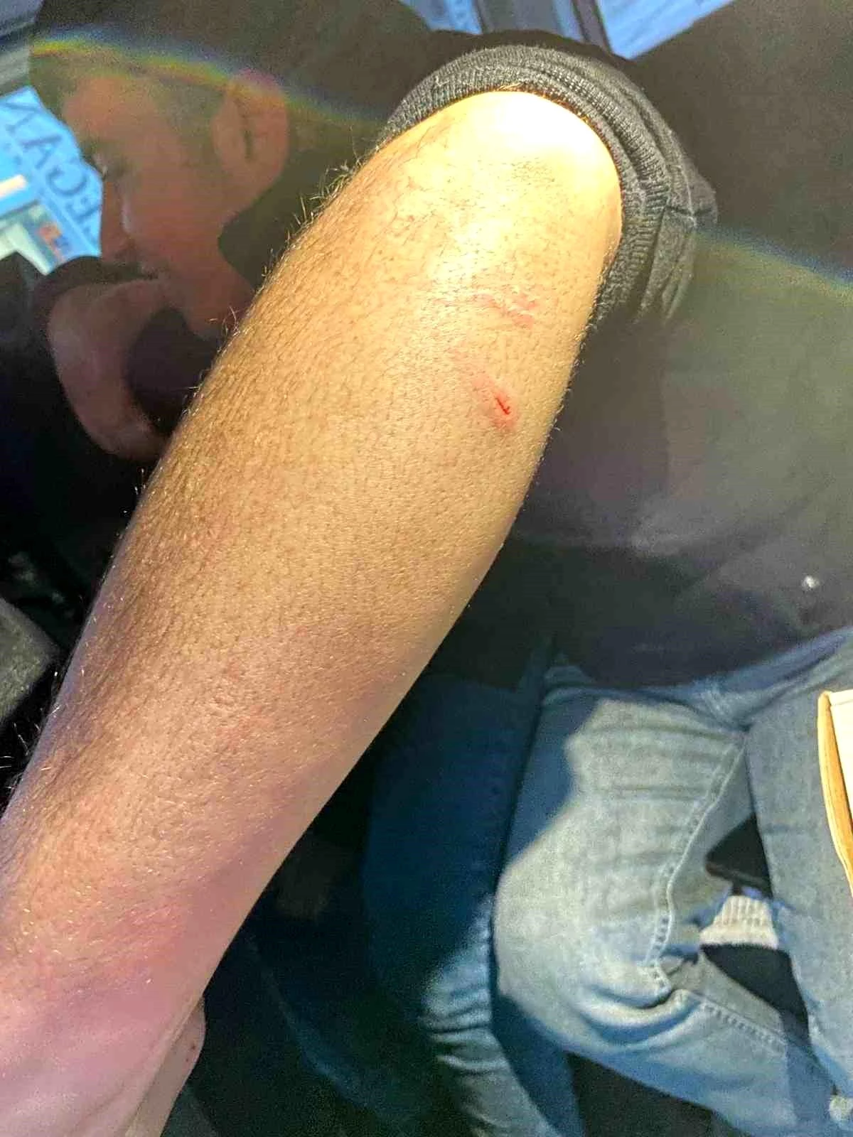 Siirt\'te sokak köpeklerinin saldırısına uğrayan genç kolundan yaralandı
