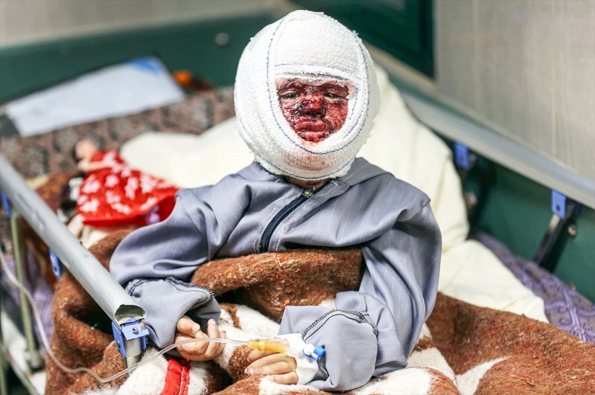 İsrail\'in saldırıları sonucu yüzü yanık 4 yaşındaki Filistinli kız çocuğu hayat mücadelesi veriyor