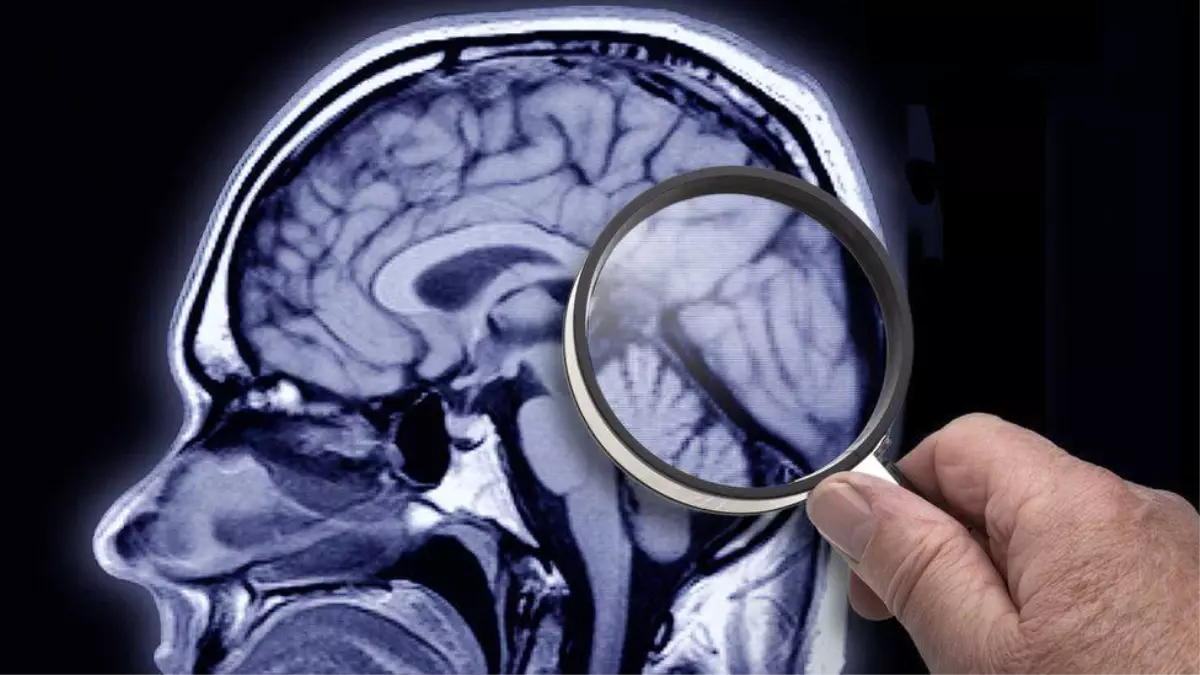 İngiltere Alzheimer hastalığını erken teşhis etmek için kan testleri yapıyor