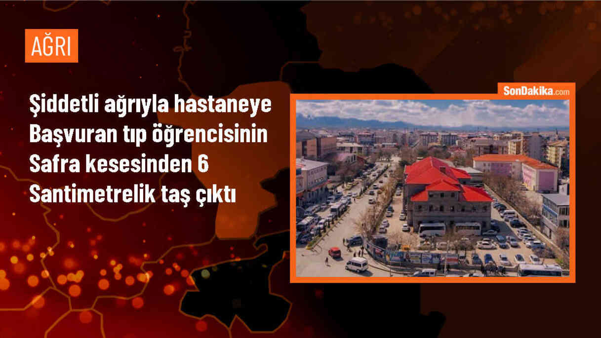 Edirne\'de Safra Kesesinden 6 Santimetrelik Taş Çıkarıldı