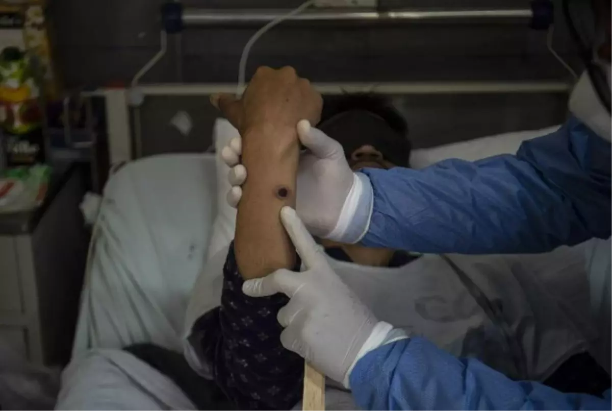 Güney Afrika\'da bir hafta içinde maymun çiçeği virüsünden ikinci ölüm vakası gerçekleşti