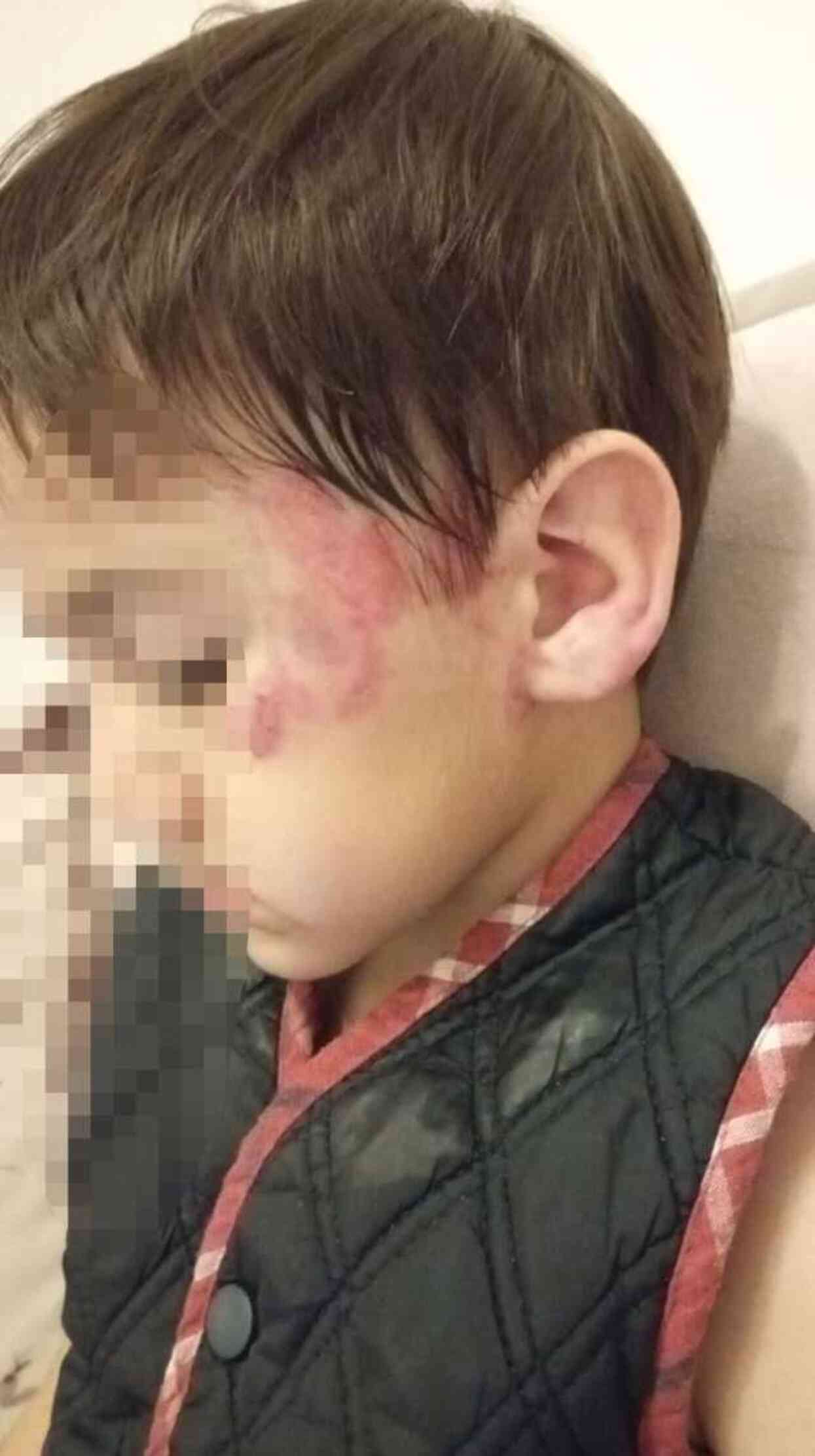 Anaokulunda 4 yaşındaki çocuk 3 yaşındaki çocuğu uyurken 13 yerinden ısırdı; aile şikayetçi oldu Anaokulunda 4 yaşındaki çocuk 3 yaşındaki çocuğu uyurken 13 yerinden ısırdı; aile şikayetçi oldu