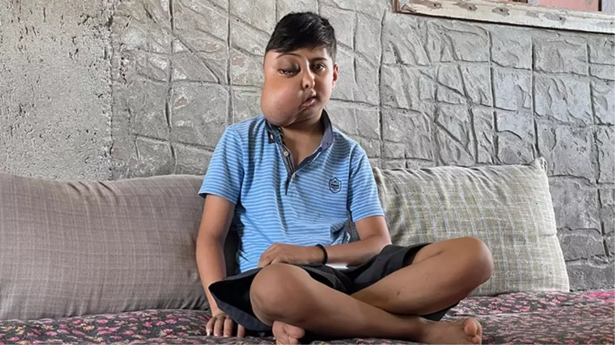 Yüzündeki kitle her geçen gün büyüyor! Küçük Enes\'in tek bir isteği var