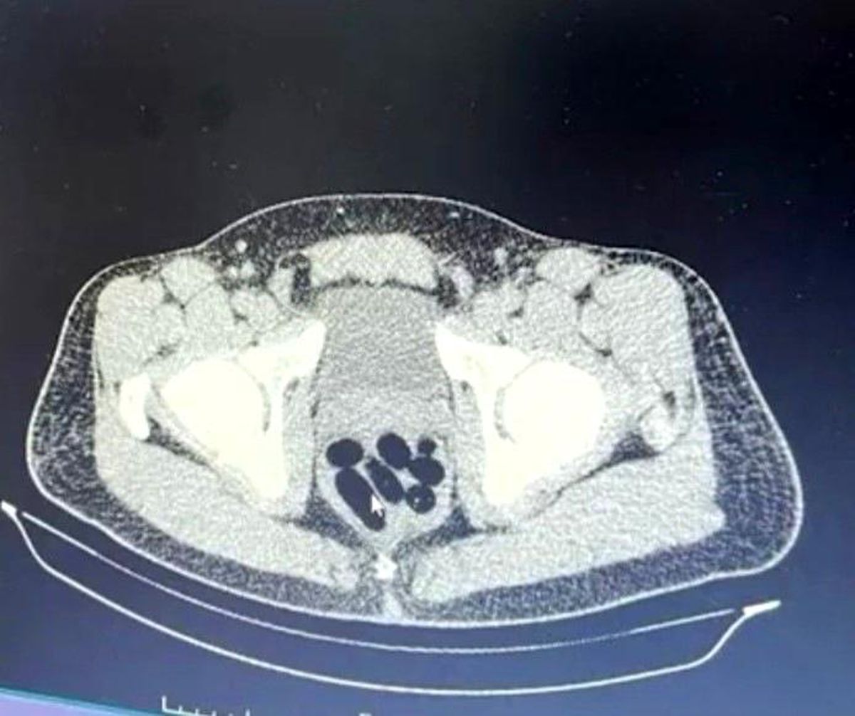 Kayseri\'de Operasyonda Bir Kişinin Midesinden 1 Kilo 134 Gram Uyuşturucu Çıktı
