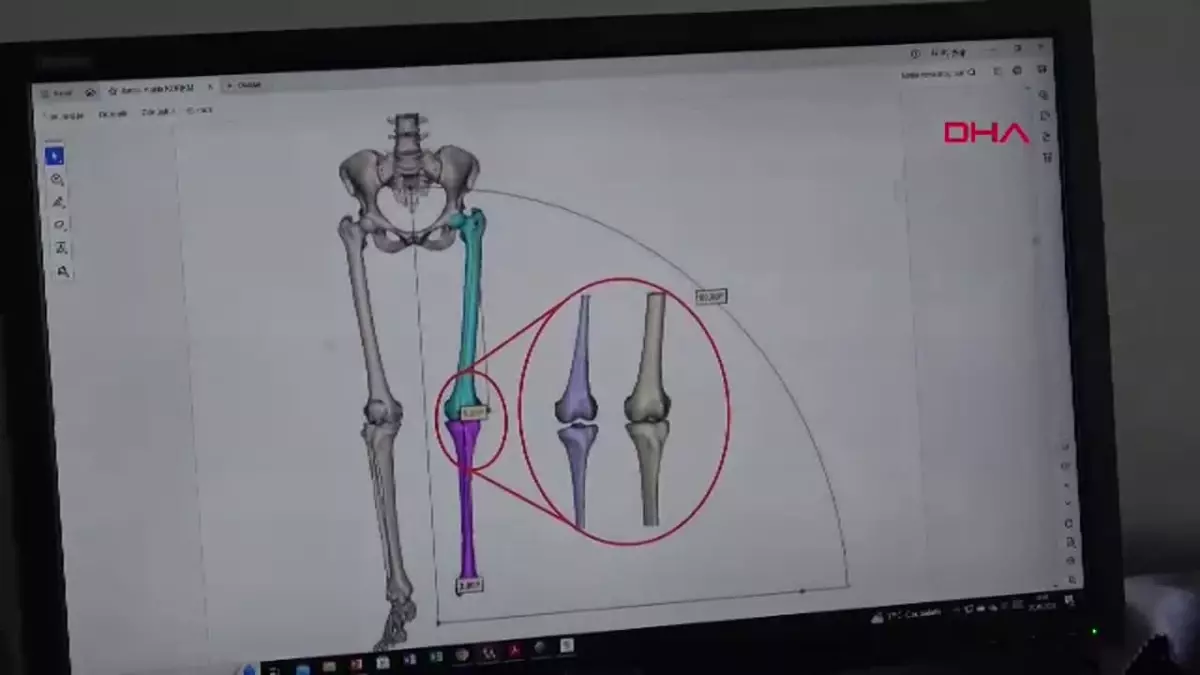 Kişiye Özel Diz İmplantı Tasarlandı