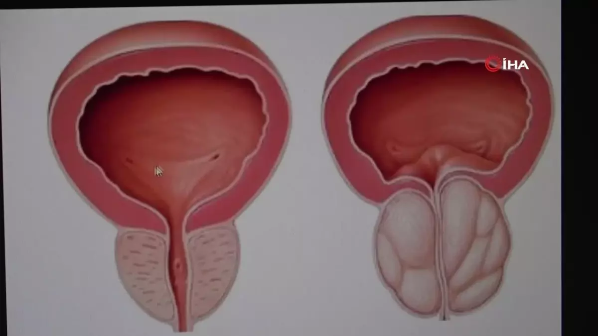 İyi Huylu Prostat Büyümesine HoLEP Çözümü