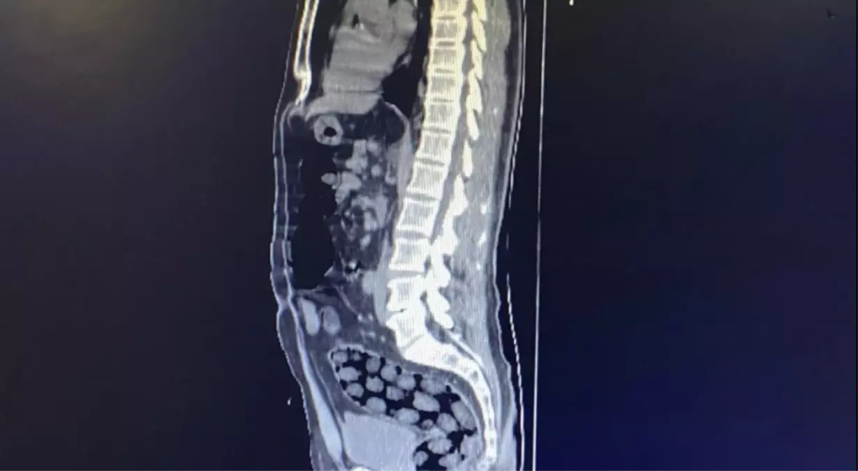 İranlı 3 yolcunun mide ve bağırsaklarından 1 kilo 126 gram metamfetamin çıktı