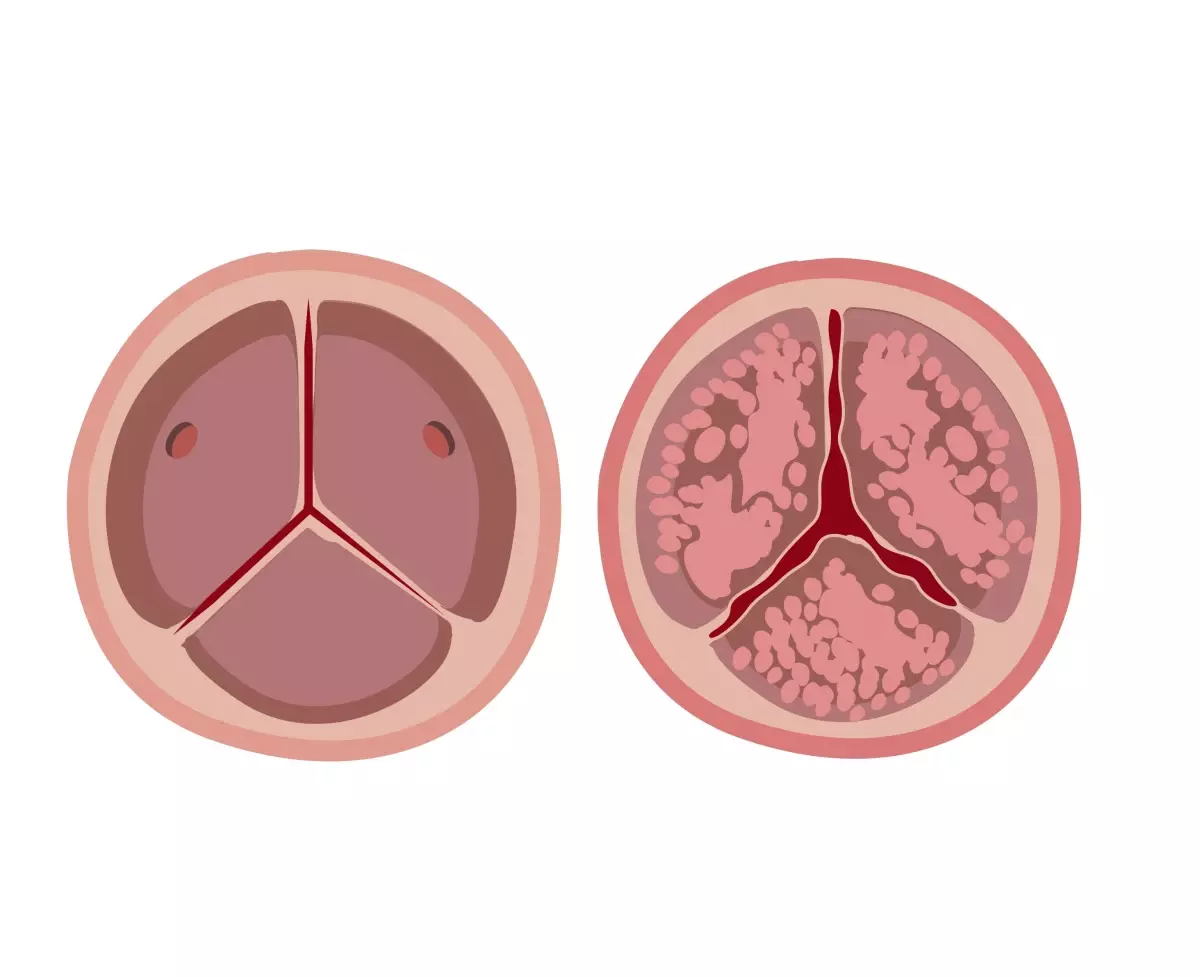 Uzmanı uyardı: Nefes darlığı ve çarpıntı kalp kapaklarındaki sorunun belirtisi olabilir
