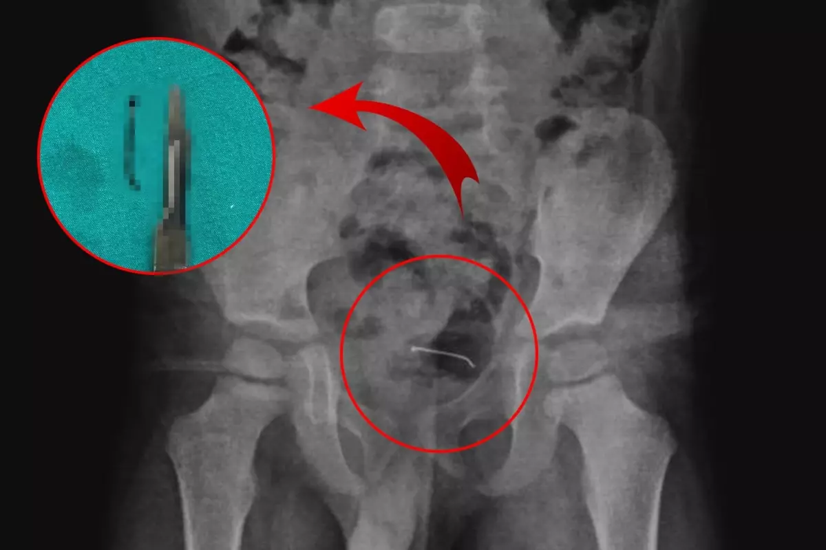 5 yaşındaki çocuğun mesane duvarından çıkan doktorları bile şoke etti