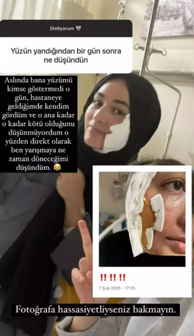 MasterChef Beyza, yanan yüzünün fotoğrafını 'Hassas içerik' notuyla paylaştı
