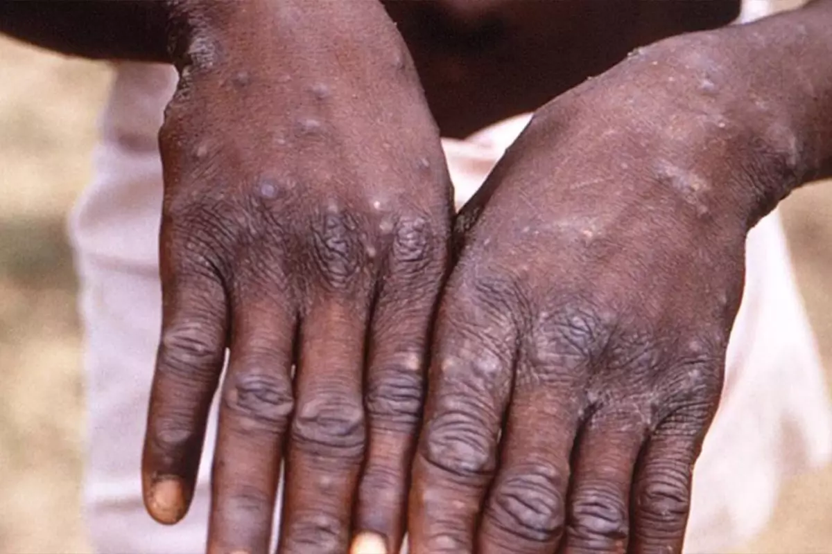 Uganda\'da M Çiçeği salgınında can kaybı sayısı 37\'ye yükseldi