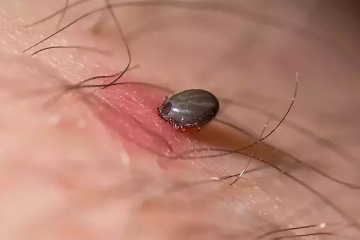 Kene ısırığı sonucu Kırım Kongo Kanamalı Ateşi\'ne yakalanan adam hayatını kaybetti