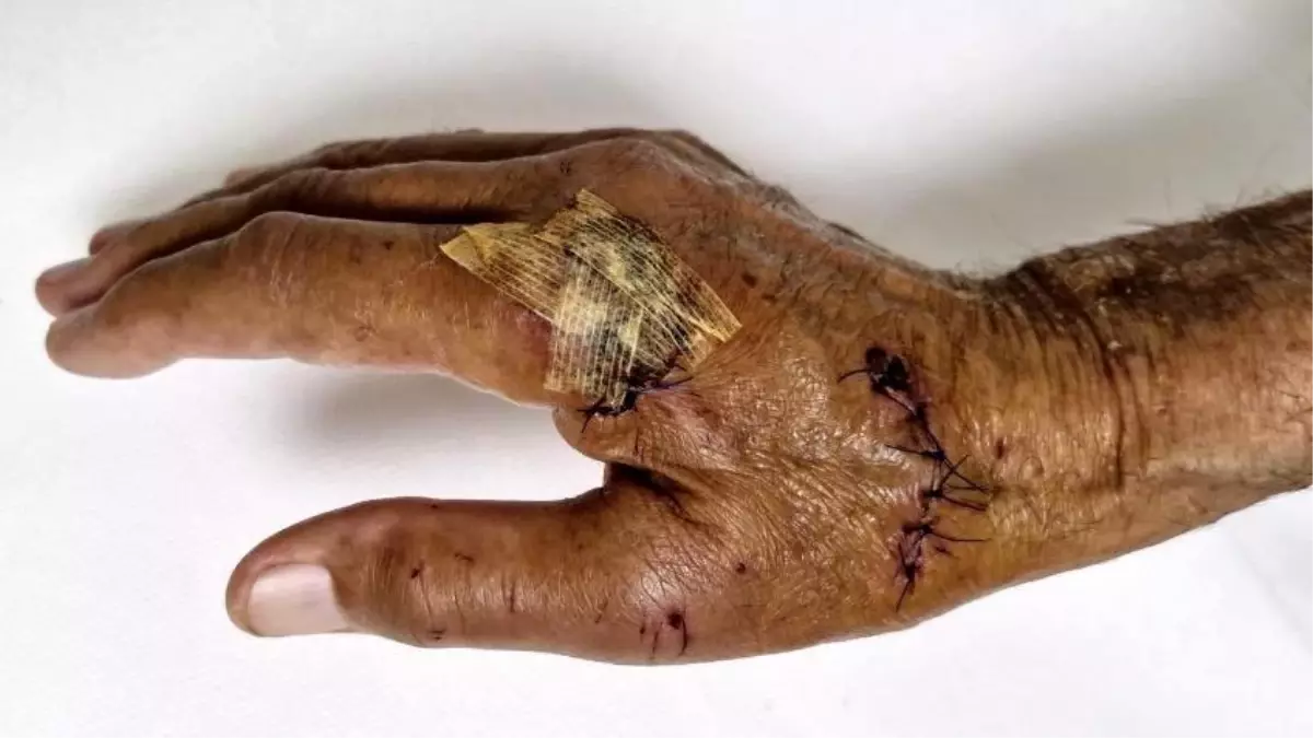 Antalya\'da Duşa Kabin Camı Patladı: 80 Yaşındaki Adam Yaralandı