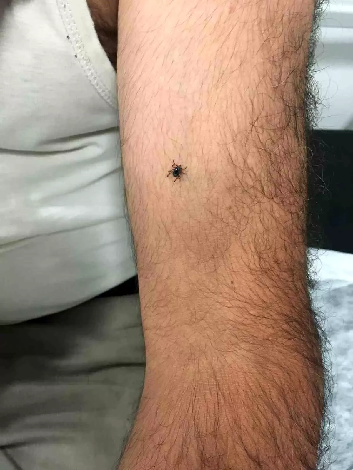 Kayseri\'de İlk Kene Vakası: KKKA Şüphesiyle Gözetim Altında