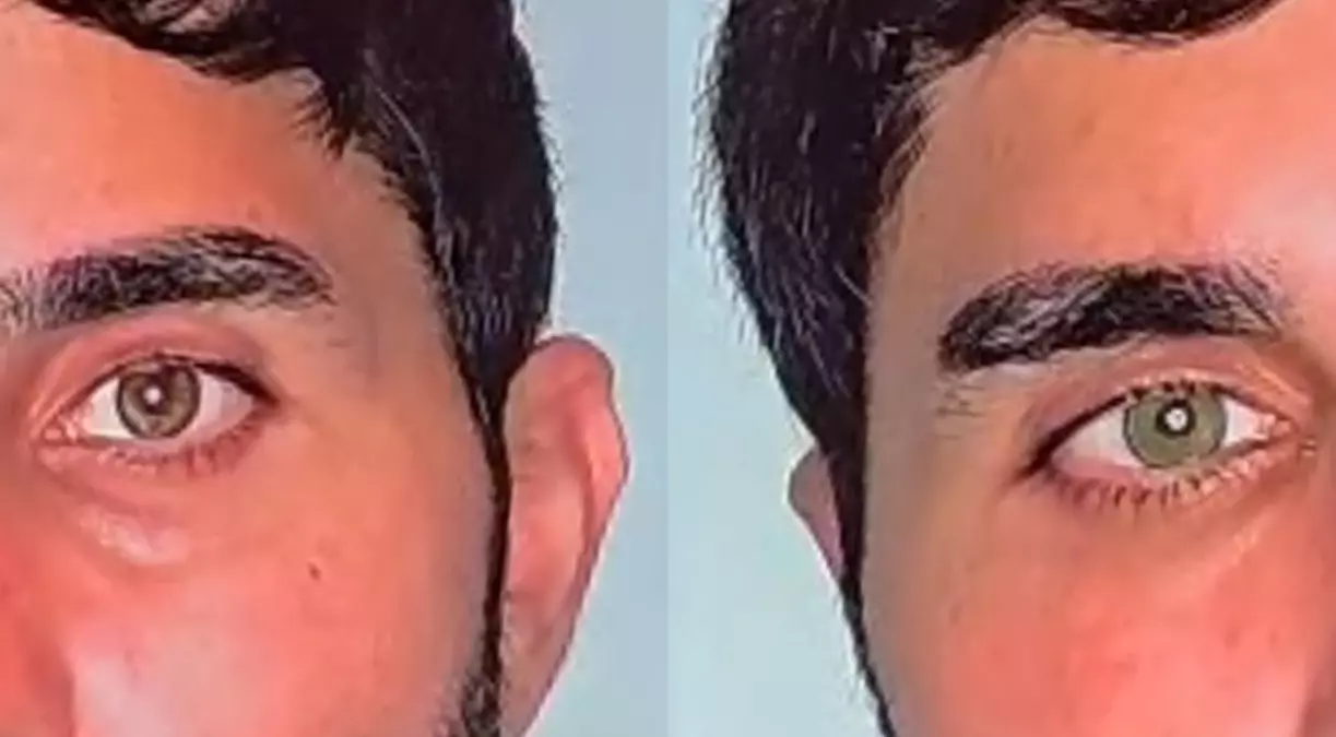 Göz Rengi Değiştirme Artık Mümkün!