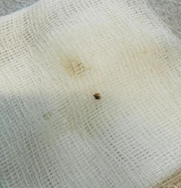 Halsizlik şikayetiyle hastaneye giden kadın hayatının şokunu yaşadı! Karnından çıkana inanamadı Halsizlik şikayetiyle hastaneye giden kadın hayatının şokunu yaşadı! Karnından çıkana inanamadı