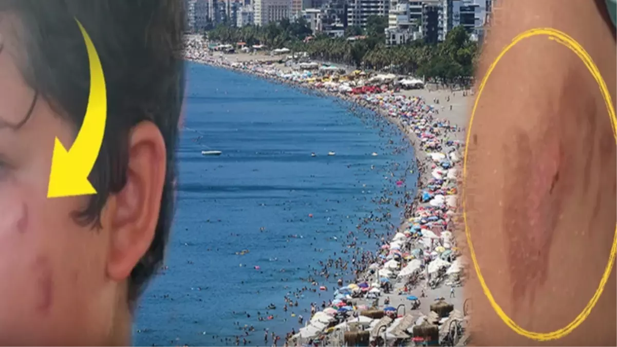 Vatandaşlar tedirgin! Denize giren yanıklarla çıkıyor