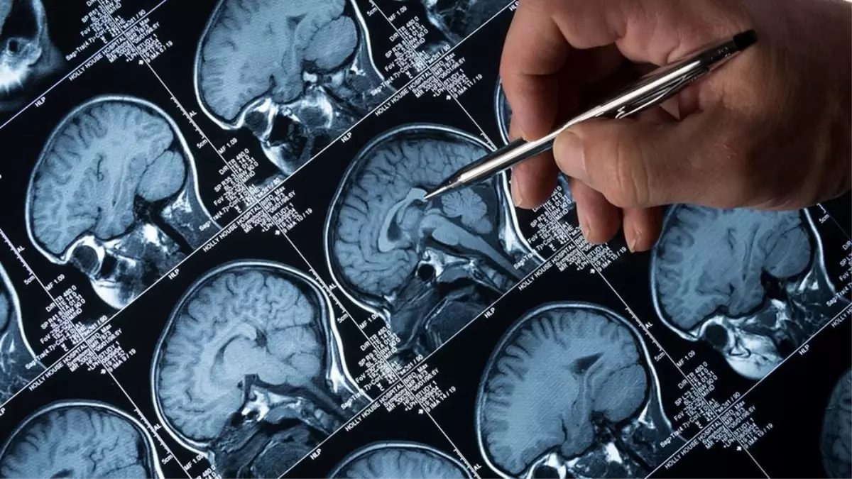 Lityum Alzheimer\'ın İlerlemesini Etkileyebilir