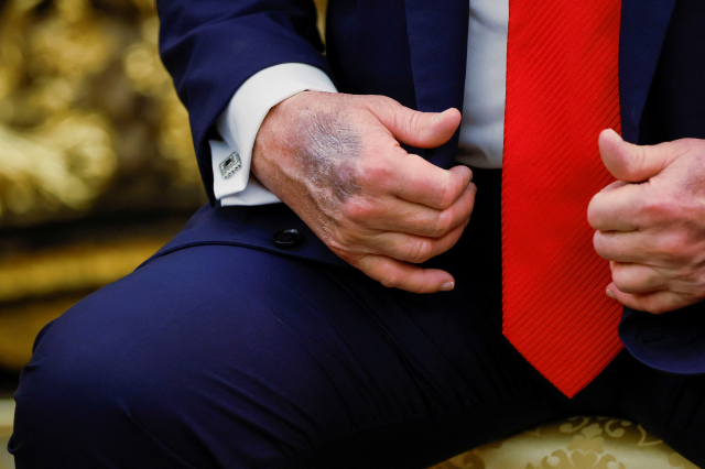 Trump'ın elindeki morluk dikkat çekti, Beyaz Saray'dan jet hızında açıklama geldi