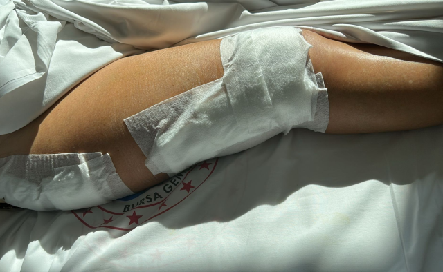 Yaşlı kadına muhtarın kullandığı sürat teknesi çarptı, kemiği kırılıp dışarı çıktı