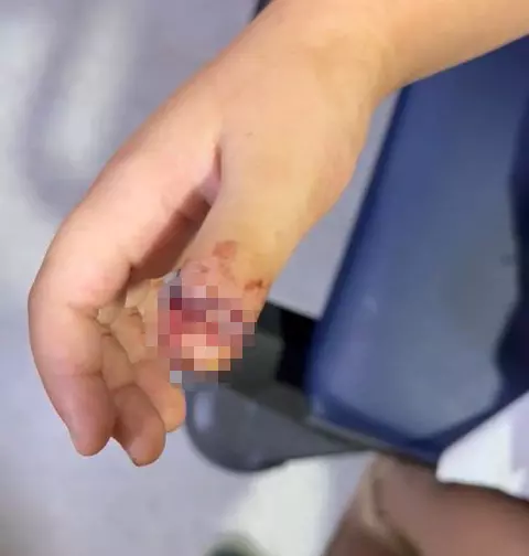 Anaokulunda ihmal! 4 yaşındaki Mavi'nin parmağı demir kapıya sıkışıp koptu Anaokulunda ihmal! 4 yaşındaki Mavi'nin parmağı demir kapıya sıkışıp koptu