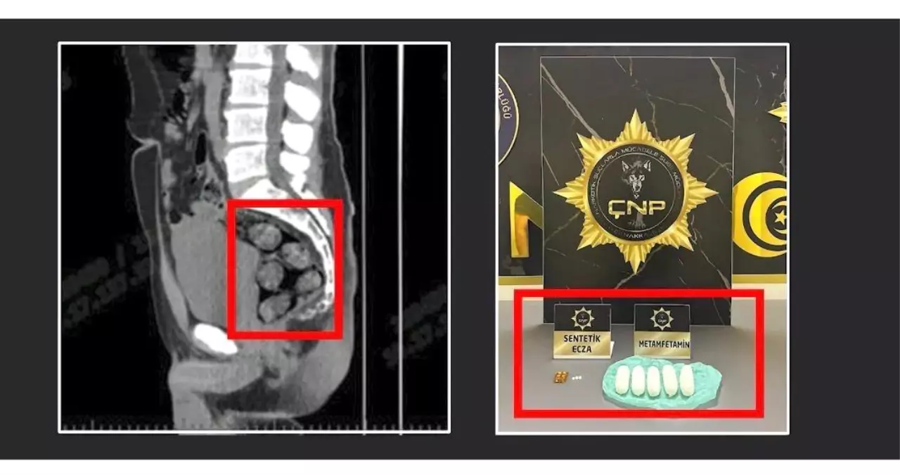 Tomografideki görüntü şoke etti! Zehir tacirleri yakayı böyle ele verdi