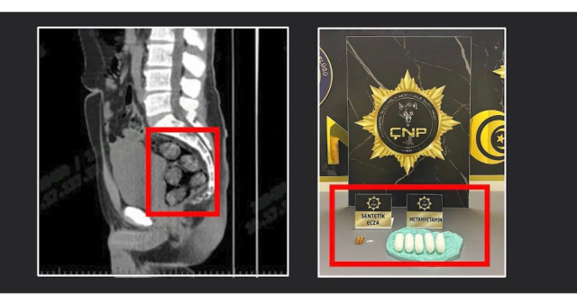 Tomografideki görüntü şoke etti! Zehir taciri yakayı böyle ele verdi