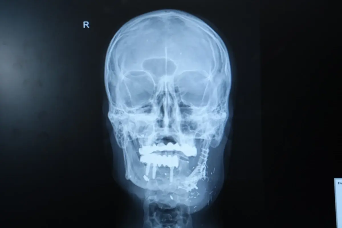 Ateşli Silah Yaralanması Sonrası Başarı